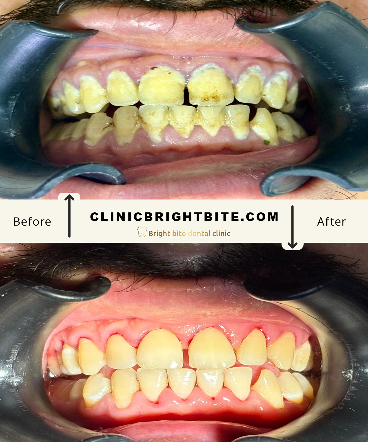 Scaling and polishing